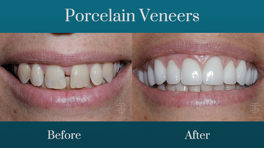 Before and after porcelain ven